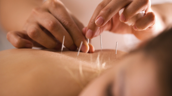 acupuncture