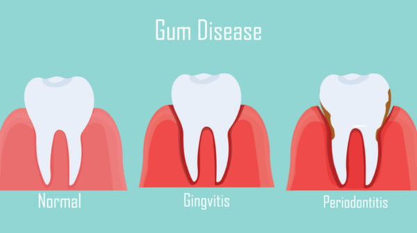 Dental care for diabetics