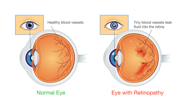 diabetes retinopathy symptoms