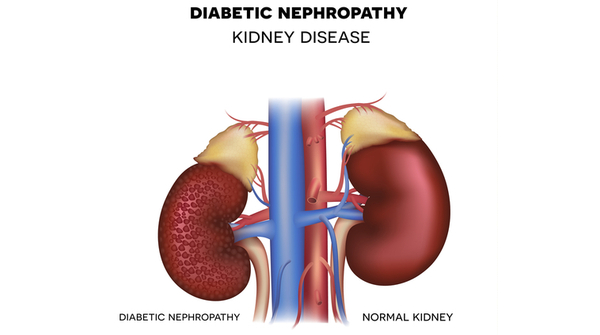 diabetic nephropathy