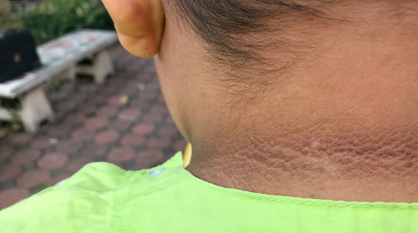 acanthosis nigricans