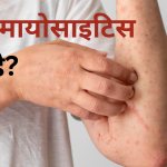 डर्मेटोमायोसाइटिस क्या है