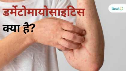 डर्मेटोमायोसाइटिस क्या है